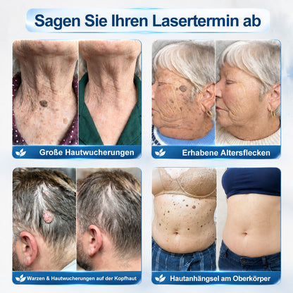 Offizieller Shop | 🎉🎁 𝐏i𝐜𝐝o® 7-Tage-Serum zur Entfernung von Hautanhängseln & Flecken (schmerzfrei, narbenfrei, Roll-On) 🔥