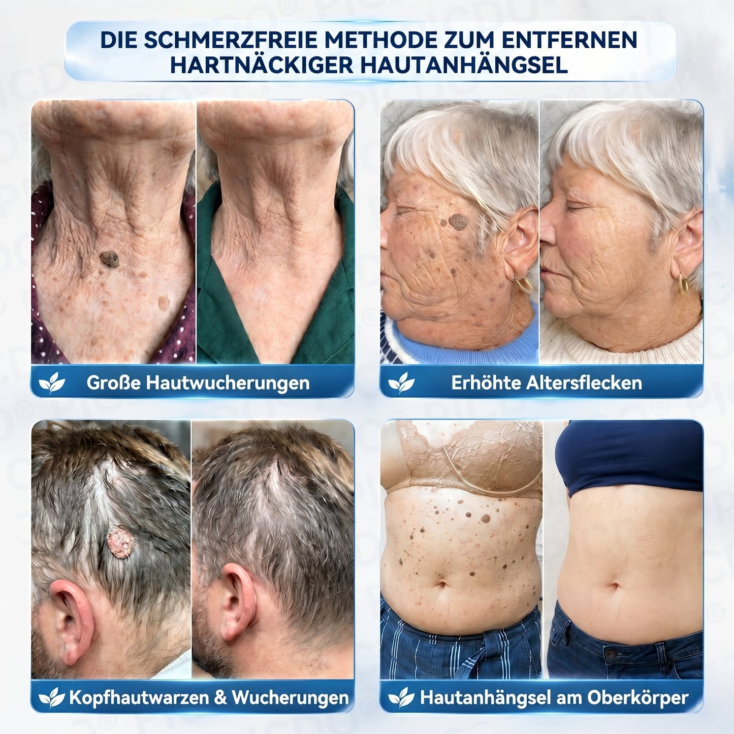 👩‍⚕️🎁𝐏𝐢𝐜𝐝𝐨® 𝟕-𝐓𝐚𝐠𝐞 𝐂𝐫𝐞𝐦𝐞 𝐆𝐞𝐠𝐞𝐧 𝐇𝐚𝐮𝐭𝐚𝐧𝐡ä𝐧𝐠𝐬𝐞𝐥- & 𝐏𝐢𝐠𝐦𝐞𝐧𝐭𝐟𝐥𝐞𝐜𝐤𝐞𝐧 (𝐒𝐜𝐡𝐦𝐞𝐫𝐳𝐟𝐫𝐞𝐢𝐞 𝐅𝐨𝐫𝐦𝐞𝐥 – 𝐨𝐡𝐧𝐞 𝐍𝐚𝐫𝐛𝐞𝐧)