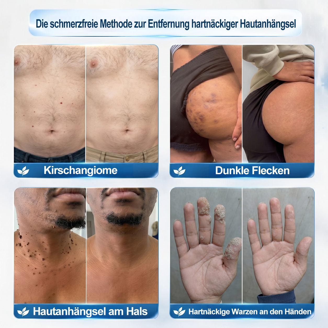 Offizieller Shop | 🎉🎁 𝐏i𝐜𝐝o® 7-Tage-Serum zur Entfernung von Hautanhängseln & Flecken (schmerzfrei, narbenfrei, Roll-On) 🔥
