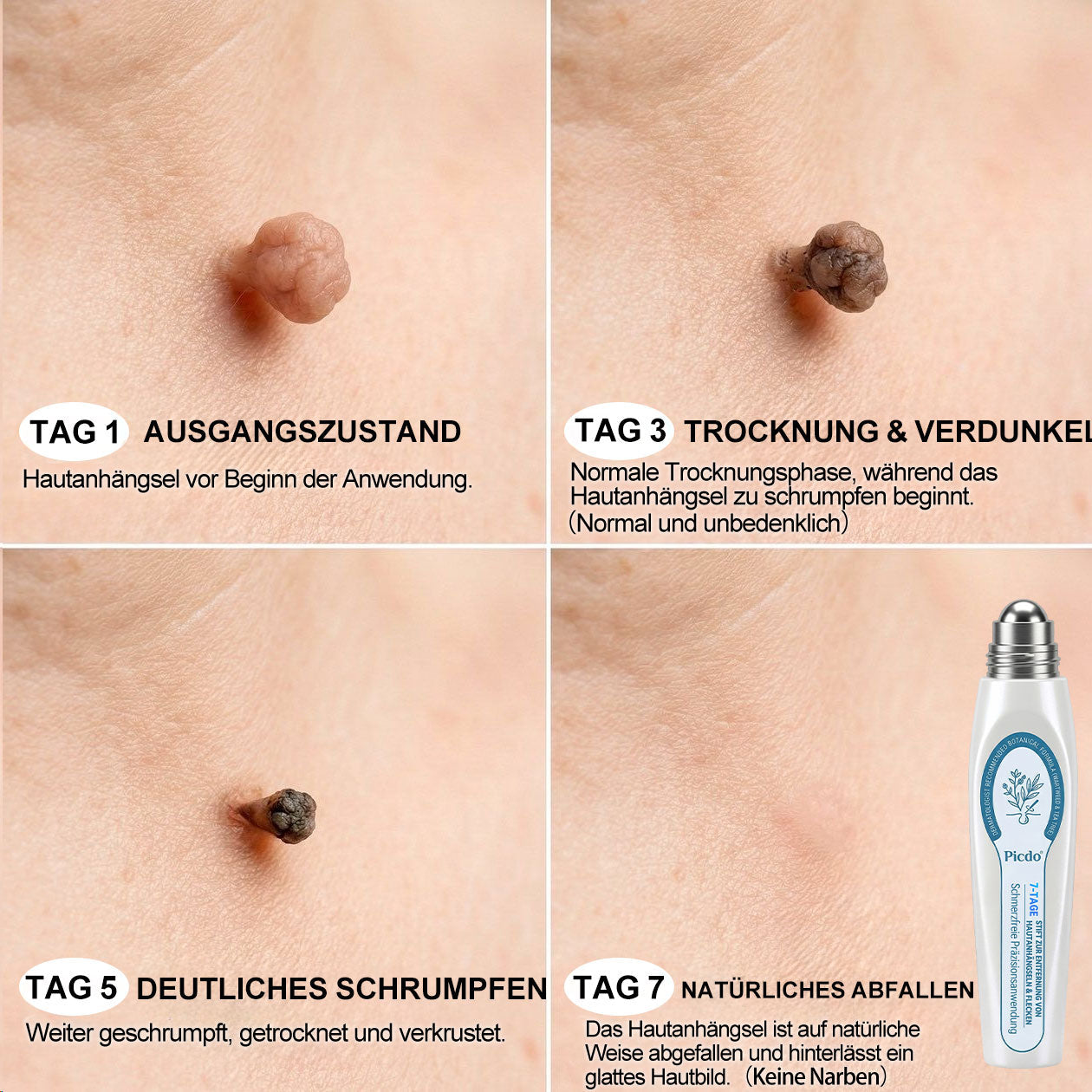 Offizieller Shop | 🎉🎁 𝐏i𝐜𝐝o® 7-Tage-Serum zur Entfernung von Hautanhängseln & Flecken (schmerzfrei, narbenfrei, Roll-On) 🔥