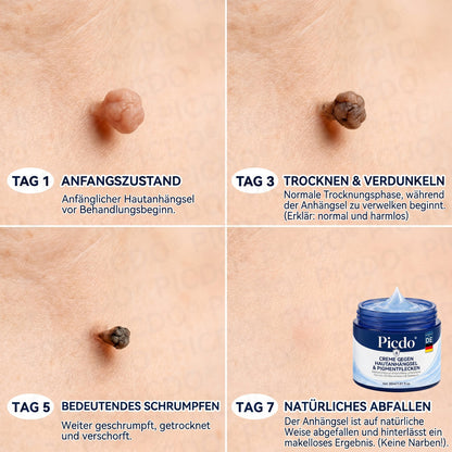 👩‍⚕️🎁𝐏𝐢𝐜𝐝𝐨® 𝟕-𝐓𝐚𝐠𝐞 𝐂𝐫𝐞𝐦𝐞 𝐆𝐞𝐠𝐞𝐧 𝐇𝐚𝐮𝐭𝐚𝐧𝐡ä𝐧𝐠𝐬𝐞𝐥- & 𝐏𝐢𝐠𝐦𝐞𝐧𝐭𝐟𝐥𝐞𝐜𝐤𝐞𝐧 (𝐒𝐜𝐡𝐦𝐞𝐫𝐳𝐟𝐫𝐞𝐢𝐞 𝐅𝐨𝐫𝐦𝐞𝐥 – 𝐨𝐡𝐧𝐞 𝐍𝐚𝐫𝐛𝐞𝐧)